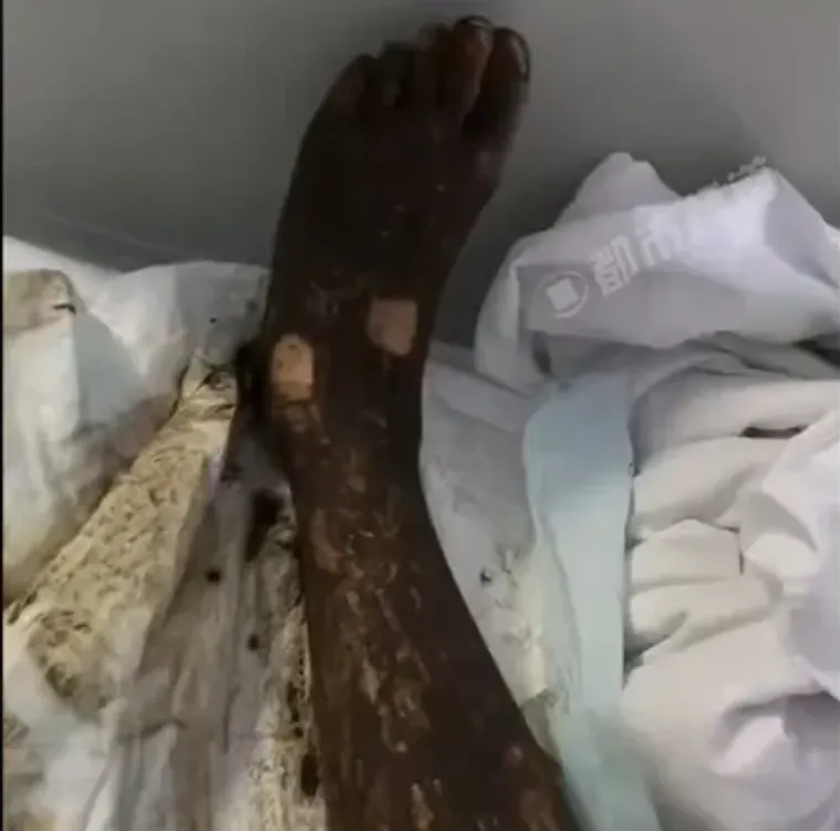 男子被咬後小腿腫脹劇烈，傷勢十分嚴重。（圖／翻攝自都市頻道）