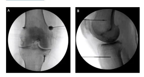 高頻熱凝療法以X光定位將電極導針導引至膝蓋的三個主要感覺神經叢，藉由熱能與電效應，麻痺痛覺神經。（台北慈濟醫院提供）