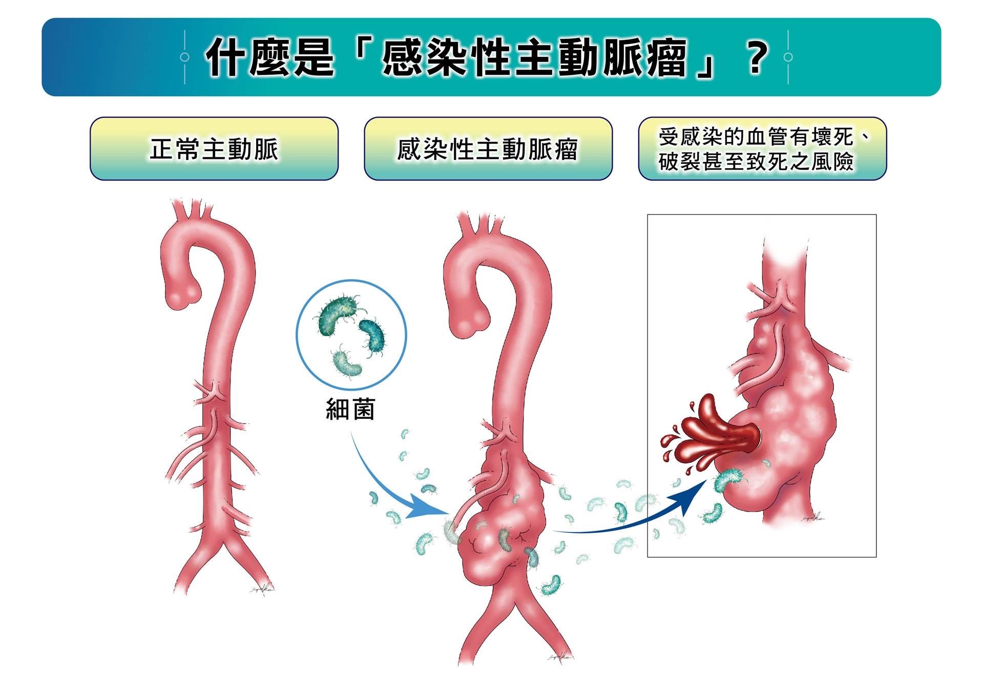 20251031-感染性主動脈瘤是由病原體（如細菌）入侵主動脈，導致血管壁壞死、破裂的罕見疾病，若未即時治療，死亡風險極高。（長庚醫院提供）
