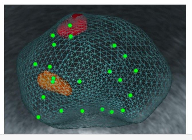 患者透過MRI與超音波融合導引切片確認為第三期攝護腺癌。（慈濟醫院提供）