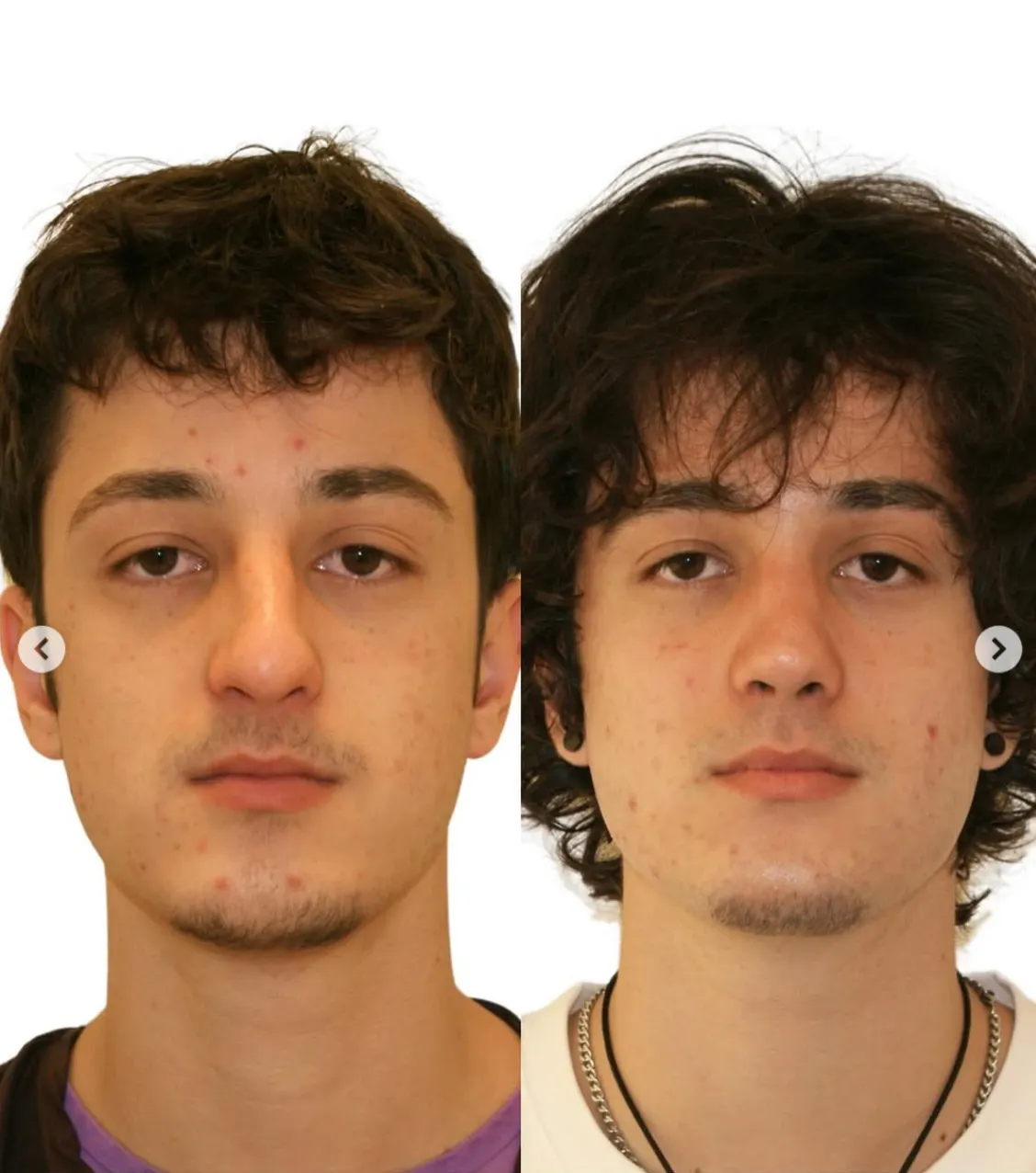 埃利亞斯尼亞（Dino Elyassnia）醫生的男性鼻整形成果：術後7個月，這位患者接受的是閉式保留式隆鼻手術，恢復狀況非常理想，鼻型精緻自然又低調。（drdinoelyassnia/ig）