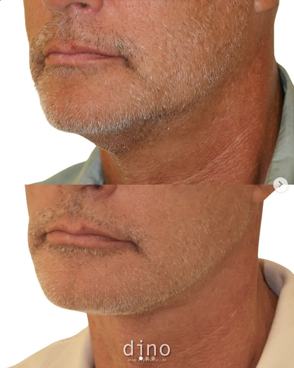 埃利亞斯尼亞（Dino Elyassnia）醫生的男性拉皮手術成果：術後一年，這位患者展現了臉部與頸部拉提搭配自體脂肪移植後的自然精緻效果。經過精心規劃的手術，不僅重塑年輕輪廓，也保留了男性特有的輪廓感。（drdinoelyassnia/ig）