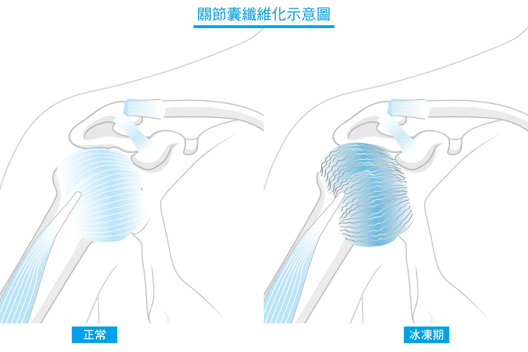 關節囊纖維化示意圖（圖／新自然主義）
