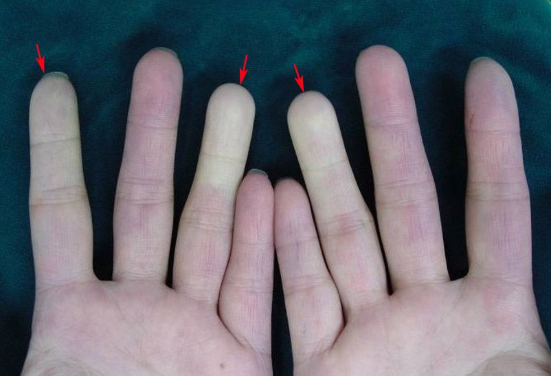 全身硬化症初期症狀是在天冷或接觸冰冷物品時，手指會變白或變紅、變紫。示意圖，非個案本人照片。（台中榮總提供）