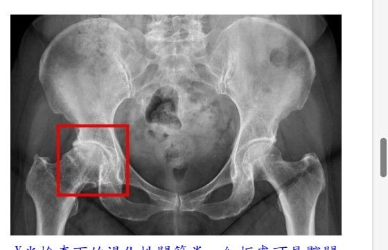 X光檢查下的退化性關節炎，紅框處可見髖關節軟骨磨損嚴重，導致骨頭間縫隙狹窄、引發發炎與疼痛。（台北慈濟醫院提供）