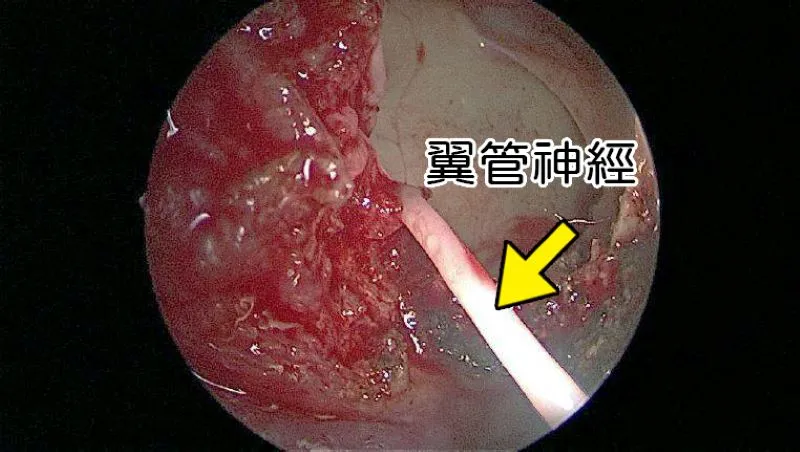 20260605-內視鏡經蝶竇找到翼管神經，將之截斷2-3公分，使過敏性鼻炎不容易復發。（台北慈濟醫院提供）