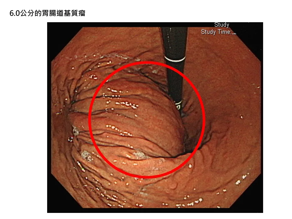 20260728-張先生胃上半部的後方有一塊直徑約6公分的隆起（紅色圈起處），經進一步的內視鏡超音波檢查合併組織取樣，診斷為胃腸道基質瘤。（書田診所提供）