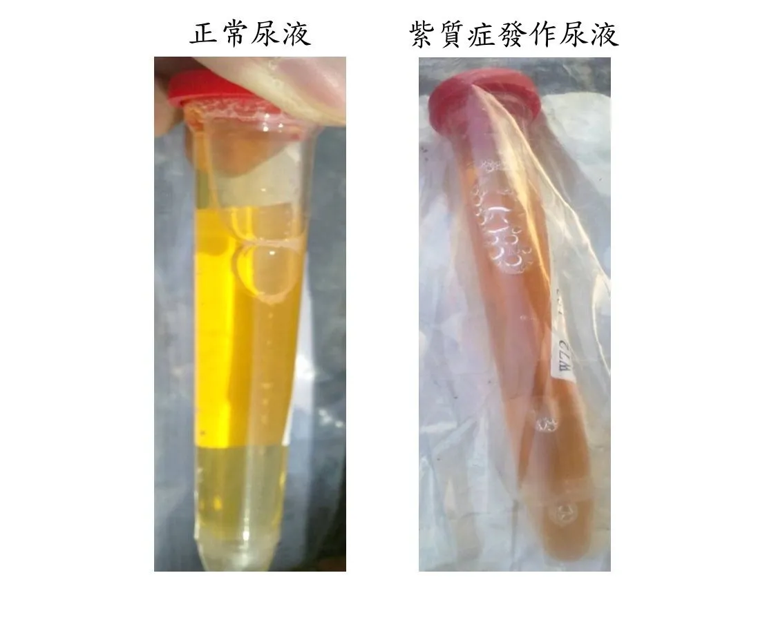 20260820-紫質症患者的尿液，發作時在光照下逐漸呈現紅棕色（右），左圖為正常尿液。（長庚醫院提供）