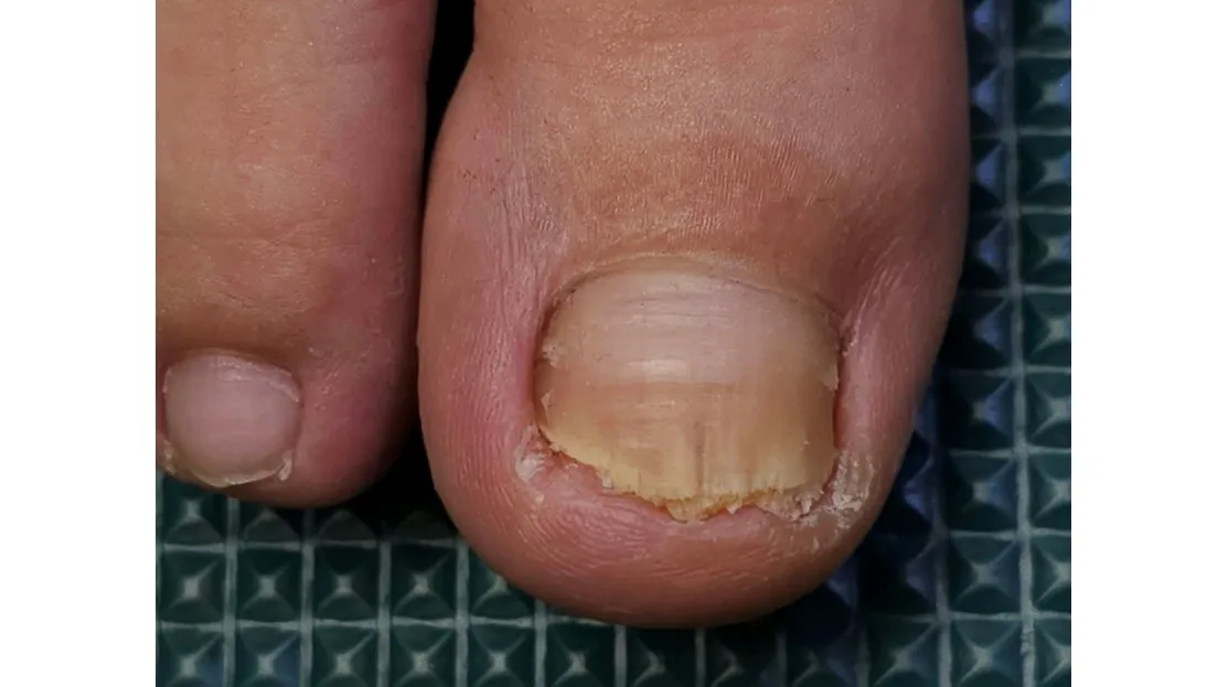 灰指甲照片 (林祺彬醫師提供)